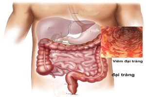 Đại tràng co thắt và hội chứng ruột kích thích khác nhau ở đâu?
